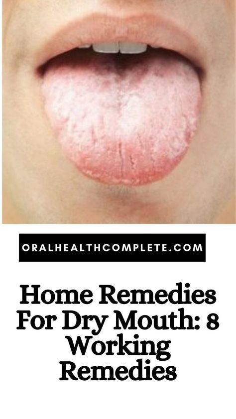 Home Remedies For Dry Mouth Dry Mouth Remedies, Pinkeye Remedies, Cold Sore Relief, Remedies For Dry Mouth, Home Remedies For Warts, Home Remedies For Allergies, Warts Remedy, Oily Skin Remedy, Sunburn Relief