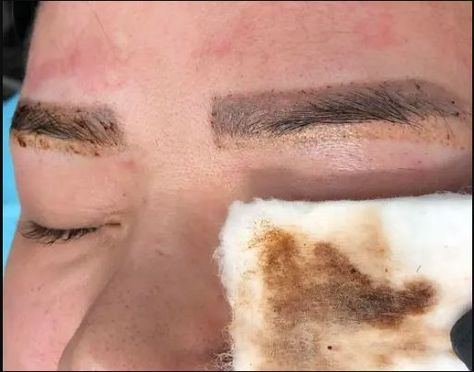 Eyebrow Tattoo Removal: How Does it Work and What to Expect Singapore Lifestyle, Picosure Tattoo Removal, Eyebrow Tattoo Removal, Tattoo Removal Cost, Laser Skin Resurfacing, Eyebrow Embroidery, Bb Glow, Web Tattoo, Laser Removal