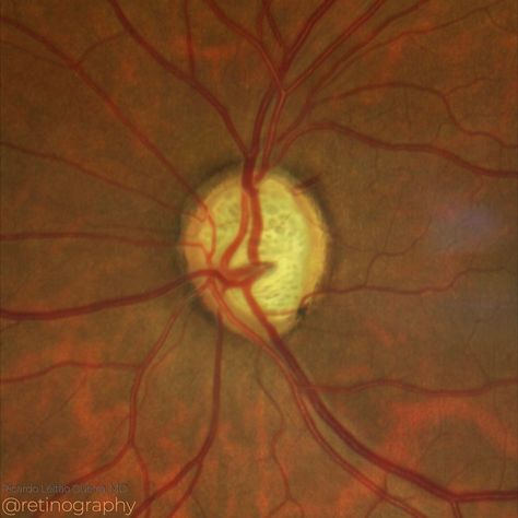 Optic Nerve, Nerve Damage, Blood Vessels, Dark Wallpaper, Nerve, Green, Photography, Color