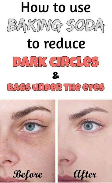 Baking Soda Under Eyes, Dark Circle Remedies, Baking Soda Face, Baking Soda Benefits, Baking Soda Uses, Baking Soda Shampoo, Reduce Dark Circles, Dark Circles Under Eyes, Face Creams