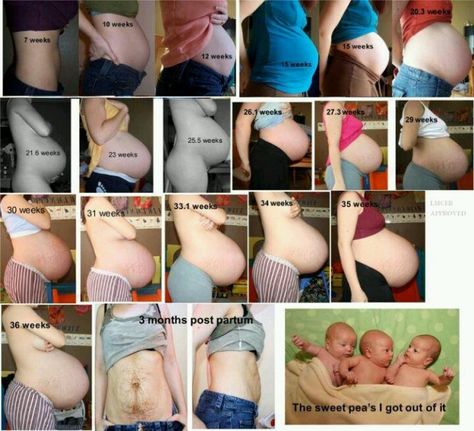 Amazing! Watch this mom's bump grow and shrink with her triplets! #triplets #multiples #bump Pregnant With Triplets Belly, 6 Week Baby, Twin Belly, Bump Progression, Baby Bump Progression, Triplets Pregnancy, Multiples Baby, Triplet Babies, Twin Pregnancy