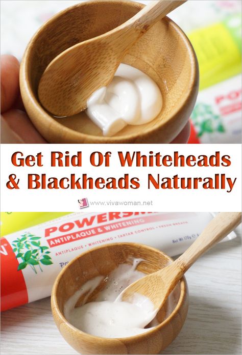 How To Remove Whiteheads And Blackheads Naturally Whitehead Removal Diy, Diy Whitehead Removal, White Head Remedies, Getting Rid Of Whiteheads On Face, Removing White Heads From Face, How To Treat White Heads On Face, How To Get Rid Of Whiteheads, How To Get Rid Of White Heads On Face, Remove White Heads From Face