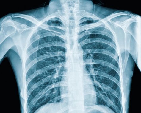 Photo xray of the lungs of an asian woma... | Premium Photo #Freepik #photo #xray #radiography #pulmonary #lung-disease Lung Xray, X Ray Vision, Xray Machine, Human Rib Cage, Medical Diagnosis, X-ray Images, Rad Tech, Branding Inspo, Lung Disease