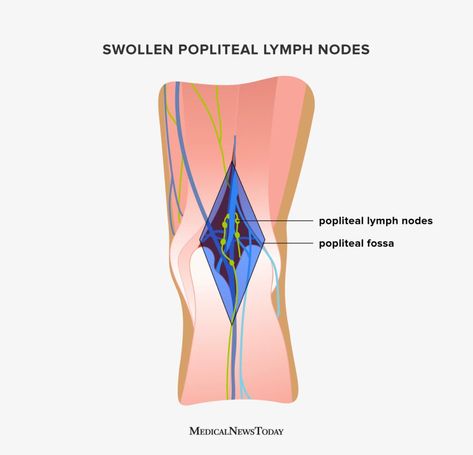 Swollen popliteal lymph nodes: Causes, anatomy, and diagnosis Lymph Node, Strep Throat, Lack Of Energy, Lymph Nodes, Fungal Infection, Knee Injury, Medical Illustration, Respiratory, How To Do Yoga