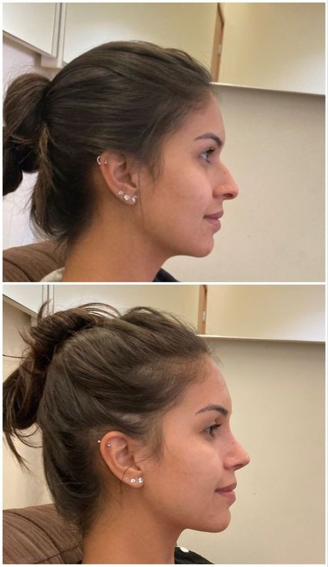 Nose Plastic Surgery, Nose Surgery Rhinoplasty, Nose Fillers, Bulbous Nose, Minimalist Ear Piercings, Rhinoplasty Nose Jobs, Face Surgery, Rhinoplasty Before And After, Pretty Nose