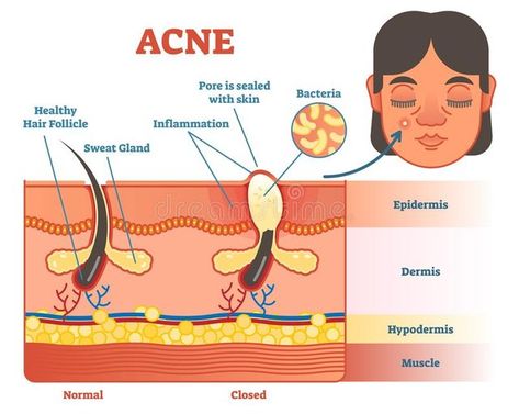 ACNE: ELIMINATING YOUR ACNE; KEY PLANS FOR CLEARING YOUR... Face Diagram, 7th Grade Science Projects, Anatomy Education, Diagram Illustration, Skin Anatomy, Perfect Skin Tone, Skin Facts, Acne Face, Sweat Gland