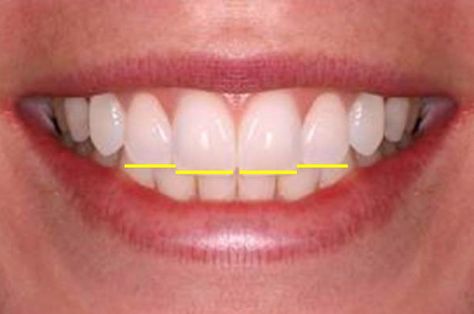 I want PERFECT TEETH! What is ideal? Ideal Smile Teeth, Teeth Shape Perfect, Best Veneers Teeth, Teeth Fangs Natural, Perfect Teeth Smile, Teeth Alignment, Wisdom Tooth Extraction, Veneers Teeth, Canine Tooth