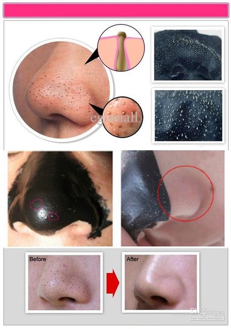 Blackheads Removing Mask Acne Remedy, Black Heads, Natural Acne, Soap Recipe, Dark Circle, Skin Therapy, Beauty Remedies, Mascara Facial, The Nose