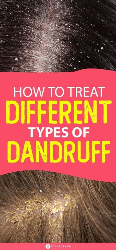 HOW TO TREAT DIFFERENT TYPES OF DANDRUFF AT HOME Bad Dandruff, Severe Dandruff, Dandruff Causes, How To Treat Dandruff, Dandruff Solutions, Home Remedies For Dandruff, Dandruff Flakes, Dry Scalp Treatment, Dandruff Remedy