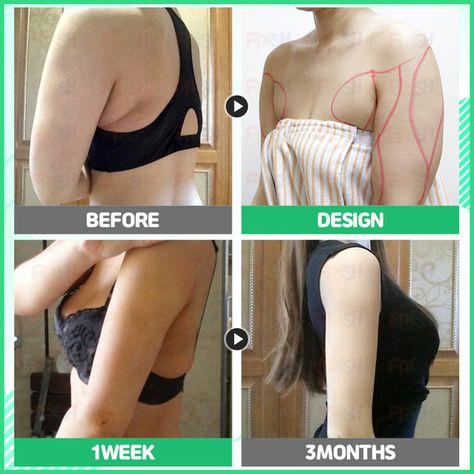 Arm Surgery Plastic Before After, Arm Lipo Before And After, Plastic Aesthetic, Lipo Before And After, Mommy Makeover Surgery, Body Contouring Surgery, Preparing For Surgery, Mommy Makeover, Outfit Plan