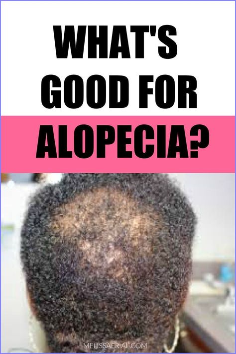 Braids For Alopecia For Black Women, Alopecia Natural Remedies, Hairstyles For Alopecia, Alopecia Hairstyles Black Women, Hair Lossing Tips, Hair Lossing, Hair Masks For Hair Growth, Masks For Hair Growth, Masks For Hair