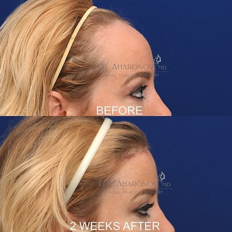 Forehead Reduction Surgery, Forehead Reduction, Face Surgery, Plastic Surgery Gone Wrong, Reduction Surgery, Facial Fillers, Facial Contouring, Celebrity Plastic Surgery, Under The Knife