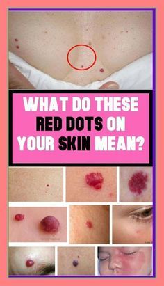 What do these red dots on your skin mean? Red Moles On Skin, Mole Meaning, Red Moles, What Is Health, Skin Moles, Health Women, Health Signs, Women Health Care, Natural Cold Remedies