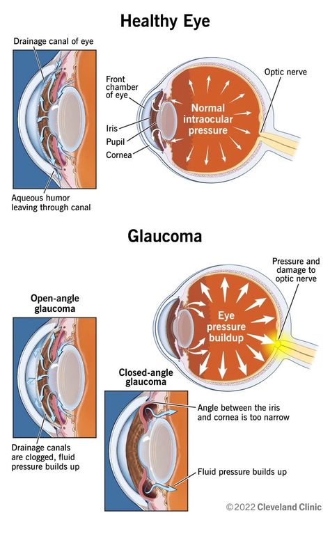 Optometry School Notes, Eye Excercise, Optometry Notes, Ophthalmology Notes, Opthalmic Technician, Eye Health Facts, Optometry Education, Nerve Injury, Optometry School