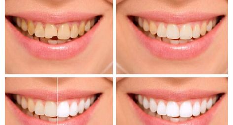 Cosmetic Dental Bonding Houston TX - Book a Free Consultation today. We offer the Best Cosmetic Tooth Bonding and are Local Dentist in Houston Tx. Here are 20 facts you need to know about Teeth Bonding. Dental Fluorosis, Cosmetic Bonding, Teeth Bonding, Cosmetic Dentistry Procedures, Dental Bonding, Dental Implants Cost, Front Teeth, Emergency Dentist, Dental Bridge