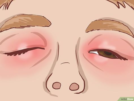 How to Treat Eczema Around the Eyes (with Pictures) - wikiHow Eyelid Excema, Staphylococci Bacteria Remedies, Itchy Eyelids, Itchy Eyes, Doterra, Make Up