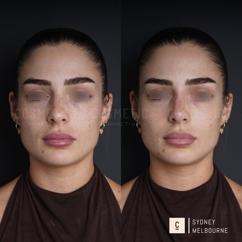 Our non-surgical rhinoplasty is a 15-minute injectable procedure that immediately improves the appearance of your nose. It’s a highly effective solution that can: - Hide bumps and humps - Lift and refine your nose tip - Slim and define your nose bridge - Balance the shape and size of your nose - Straighten a crooked nose - Improve poor surgical rhinoplasty results ⁠ Did you love this result? Want to know if it's right for you? Comment 'NOSE' to claim your complimentary opinion. ⁠⁠⁠ This con... Nose Tip, Crooked Nose, Nose Bridge, Bridge