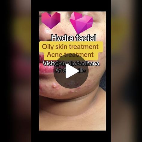 TikTok · StudioSadhana Facial For Oily Skin, Hydra Facial, Oily Skin, Twitter Card, Twitter Image, Facial, Acne, Skin