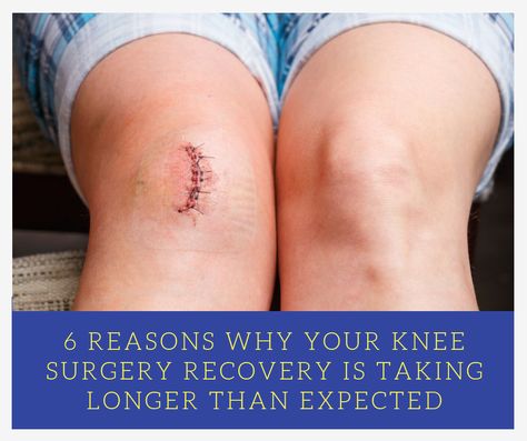 Is your knee surgery recovery time not going as fast as you'd like?  Have a look at our recent post where you'll discover 6 things that you might be doing to sabotage your recovery.   #knee #surgery Meniscus Surgery Recovery, Arthroscopic Knee Surgery, Knee Replacement Surgery Recovery, Meniscus Surgery, Knee Replacement Exercises, Knee Replacement Recovery, Partial Knee Replacement, Knee Surgery Recovery, Acl Recovery