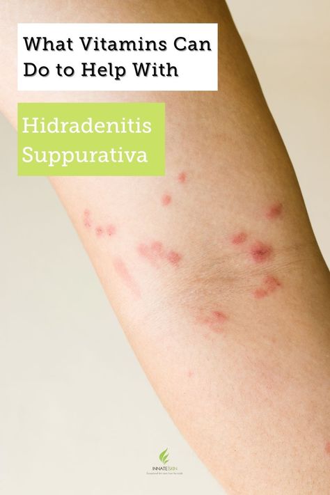 Hs Skin Disease Natural Remedies, Hs Remedies, Hidradenitis Remedies, Hs Disease, Acne Vitamins, Back Acne Remedies, Baby Cough Remedies, Chronic Sinusitis, Skin Diet