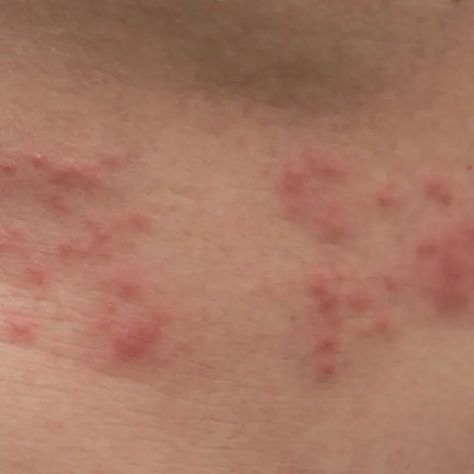 9 Questions to Ask Your Doc About the Shingles Vax Shingles Symptoms Signs, Shingles On Face, Signs Of Shingles, Are Shingles Contagious, Shingles Remedies, Shingles Relief, Shingles Rash, Face Pictures, Surprising Facts