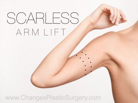 Scarless Arm Lift | The Future of Brachioplasty Arm Lift Surgery, Skin Removal Surgery, Skin Tightening Procedures, Home Remedies For Skin, Extra Skin, Arm Lift, Cool Sculpting, Upper Arms, Fat Removal