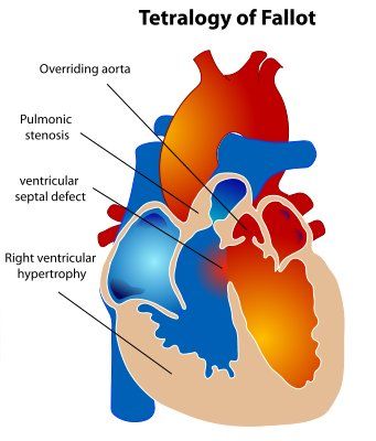 Tetralogy of Fallot (4 defects) Tetralogy Of Fallot, Acupuncture Benefits, Heart Valves, Normal Heart, Congenital Heart Defect, Heart Defect, Congenital Heart, Heart Conditions, Heart Surgery