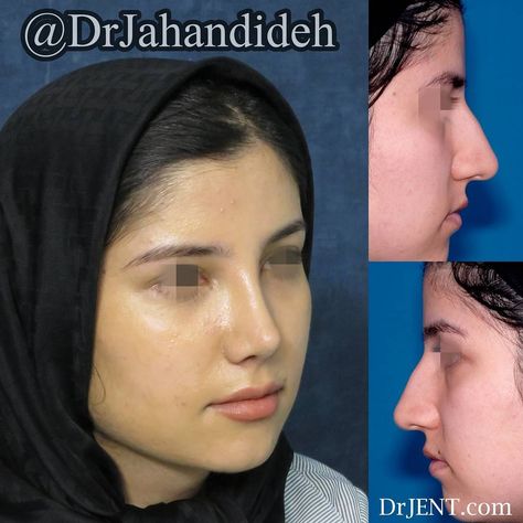 Rhinoplasty Nose Jobs Asian, Ideal Nose Rhinoplasty, Nosejob Rhinoplasty Before After, Droopy Tip Nose Rhinoplasty, Rhinoplasty Bulbous Tip, Hooked Nose, Beautiful Nose, Ancient Chinese Dress, Pretty Nose