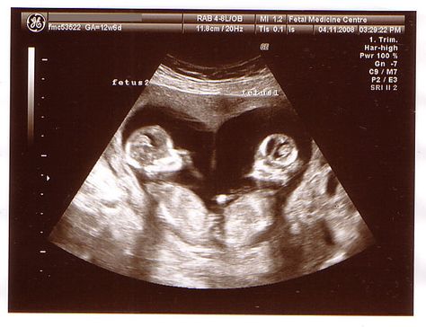 twin fetus at 20 weeks | twin b head twin a head twin b hand twin a hand Twins Ultrasound, 12 Week Scan, Baby Ultrasound Pictures, Twin Baby Boys, Baby Ultrasound, Ultrasound Pictures, Baby Scan, Twin Pregnancy