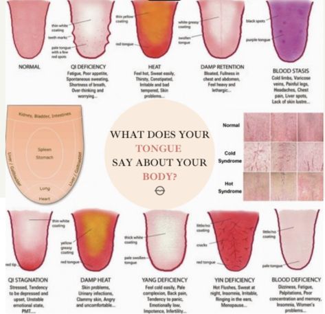 Healthy Tongue, Qi Deficiency, Tcm Traditional Chinese Medicine, Eastern Medicine, Tongue Health, Traditional Medicine, Alternative Health, Traditional Chinese Medicine, Holistic Healing