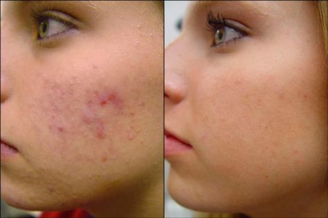 Cheek Acne, Pimples On Buttocks, Acne Facial, Cystic Acne, Scar Removal, Acne Remedies, How To Get Rid Of Acne, Prevent Acne, Pharmacology