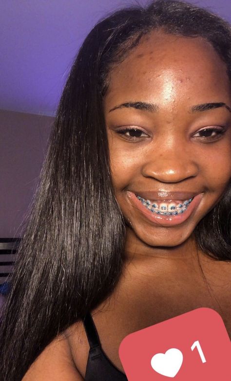 Black Girls With Braces, Dark Blue Braces, Light Blue Braces, Braces Journey, Dental Braces Colors, Braces Colors Combinations, Blue Braces, Braces Cute, Green Braces