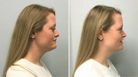 Wondering how to get rid of double chin? I did 3 rounds of Kybella injections – learn all about it and see Kybella before and after photos and video! Have you ever photoshopped a photo of yourself? Have you ever wanted to? For me the thing that always caught my attention was the bit of […] The post My Kybella Before and After – How to Get Rid of Double Chin appeared first on Amber Oliver. Chin Before And After Filler, Kybella Before And After, Kybella Before And After Double Chin, Kybella Injections, Remove Double Chin Photoshop, Face Fat Loss Double Chin How To Get Rid, Pain Scale, Chubby Cheeks, Double Chin