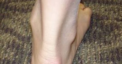 Retrocalcaneal Bursitis, Haglunds Deformity, Alternative Shoes, Heel Pain, Foot Pain, Bump, The Back, Pumps