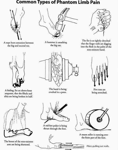 Types of phantom pain. Phantom Limb, Phantom Pain, Pta School, Broken Ankle, Occupational Therapy Activities, Chronic Pain Relief, Prosthetic Leg, Hand Therapy, Broken Leg