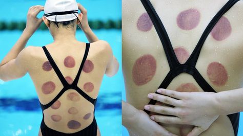 Behind Olympic Cupping, a Story Rooted in Ancient Religions Wet Cupping, Benefits Of Cupping, Hijama Cupping, Sports Massage Therapy, Ear Candling, Cupping Therapy, Rio Olympics, Healing Therapy, Healthy Diet Recipes