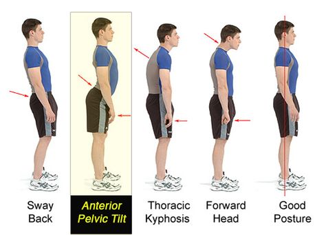 How to retain a proper posture when sitting, standing, walking? - Physical Fitness Stack Exchange How To Get Tall, Anterior Pelvic Tilt, Grow Taller Exercises, Posture Correction Exercises, Taller Exercises, Posture Fix, Pelvic Tilt, Posture Exercises, Perfect Posture