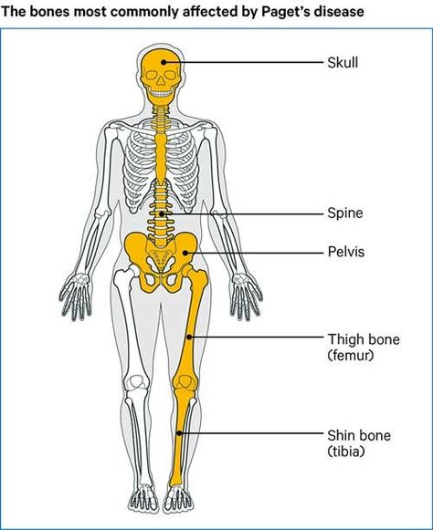 Paget's disease of bone | Causes, symptoms, treatments Pagets Disease, Complementary Medicine, Bone Diseases, Calcium Supplements, Genetic Testing, Blood Test, Disease, Bones, The Way