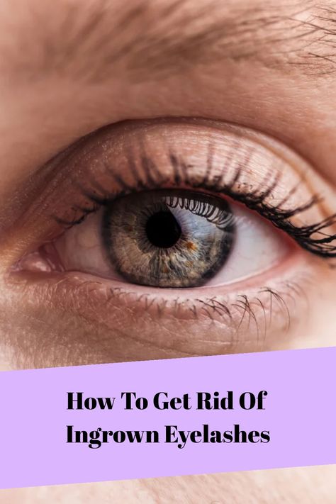 Ingrown Eyelash Home Remedy: Fix That Ingrown Lash Grow Lashes, How To Grow Eyelashes, Prevent Ingrown Hairs, How To Apply Eyeliner, Beauty Games, Medical Help, Makeup Techniques, Laser Hair, Eye Care