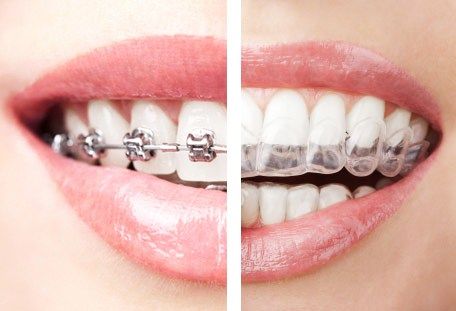 Invisalign Aligners, Invisalign Braces, Getting Braces, Traditional Braces, Invisible Braces, Kedokteran Gigi, Clear Braces, Dental Braces, Metal Braces