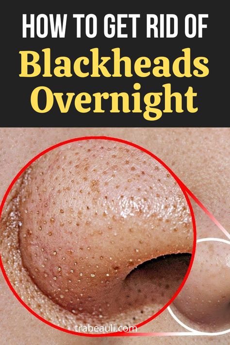 They appear to be black in color, because of the dirt and oil deposited in the skin. So know about how to remove blackheads at home. #blackheads #skincare How To Remove Blackheads, To Remove Blackheads, Rid Of Blackheads, Holistic Recipes, Black Heads, Organic Recipes Healthy, Remove Blackheads, Organic Remedy, Get Rid Of Blackheads