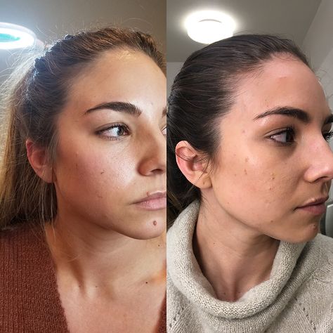 My Experience Receiving Botox for TMJ | Lauryncakes Botox Jaw, Jaw Pain Relief, Tmj Relief, Botox Before And After, Botox Lips, Hair Dye Shampoo, Jaw Pain, Brown Hair Dye, Botox Fillers