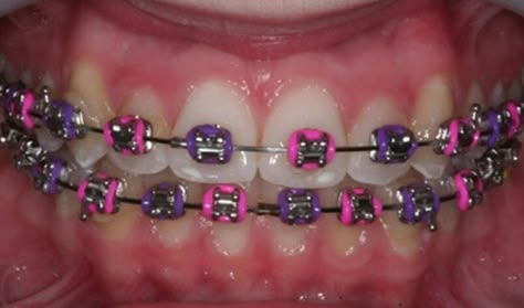 Purple Braces, Dental Braces Colors, Braces Colors Combinations, Invisible Teeth Braces, Pink Braces, Red Braces, Braces Retainer, Braces Colors Ideas