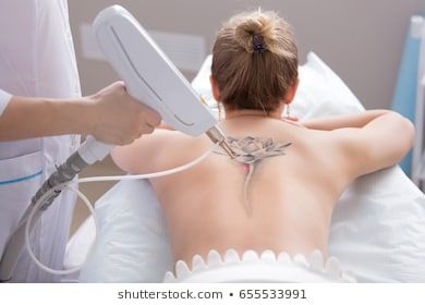 Tattoo Images, Stock Photos & Vectors | Shutterstock Surgeon Tattoo, Common Tattoos, Tattoo Removal Cost, No Regrets Tattoo, Laser Removal, Invisible Ink, Laser Tattoo, Old Tattoos, Laser Tattoo Removal