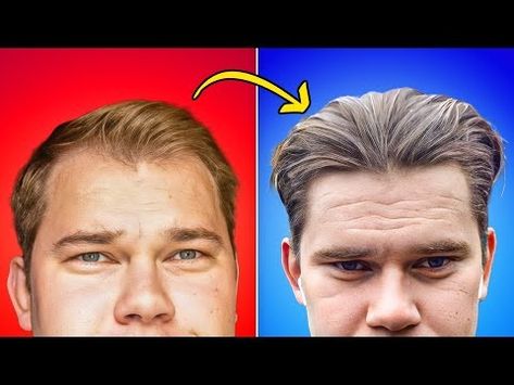 How Did I Regrow Hairline In 12 Months - YouTube Regrow Hairline, Hair Regrowth, 12 Months, How To Apply, Hair