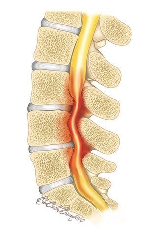 The Impact of Spinal Stenosis on Daily Life - Southern California Brain & Spine Surgery I Los Angeles Spine Surgeon Stenosis Of The Spine, Spinal Fusion, Spinal Decompression, Spine Surgery, Surgery Center, Spinal Cord, Back Pain, Southern California, Daily Life