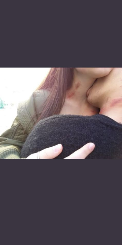 Back Of Neck Kiss, Hicks On Neck, Hickies Neck, Kiss Mark, Grunge Couple, Bed Bug Bites, I Want A Relationship, Couple Goals Teenagers Pictures, Fit Couple