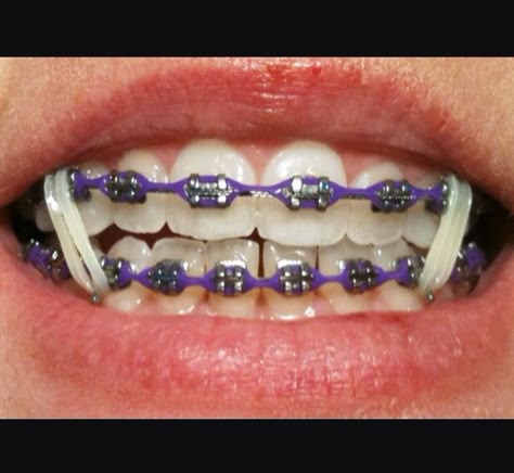 Purple Braces Power Chain Smile With Braces, Purple Braces, Power Chain Braces, Dental Braces Colors, Invisible Teeth Braces, Braces Colors Combinations, Braces Colours, Braces Rubber Bands, Braces Ideas