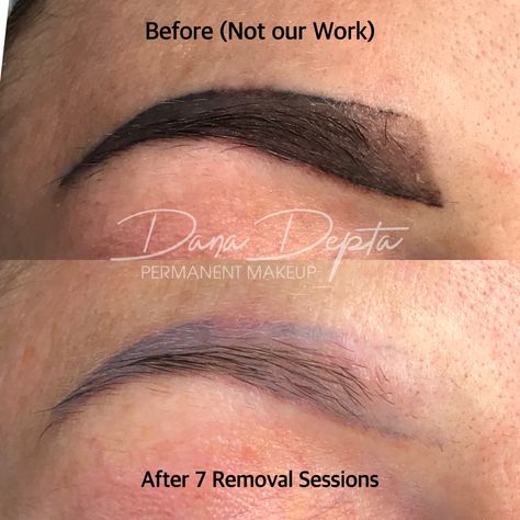 Bad Microblading, Permanent Makeup Removal, Pmu Brows, Semi Permanent Makeup, Makeup Removal, Eyebrow Tattoo, Tattoo Removal, Permanent Makeup, Microblading