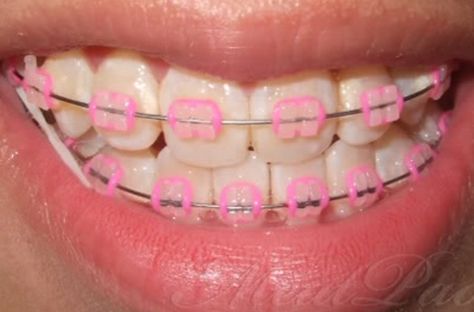 ❤️ Braces Funny, Power Chains, Braces Colors Combinations, Pink Braces, Braces Bands, Ceramic Braces, Cute Braces Colors, Types Of Braces, Kids Braces